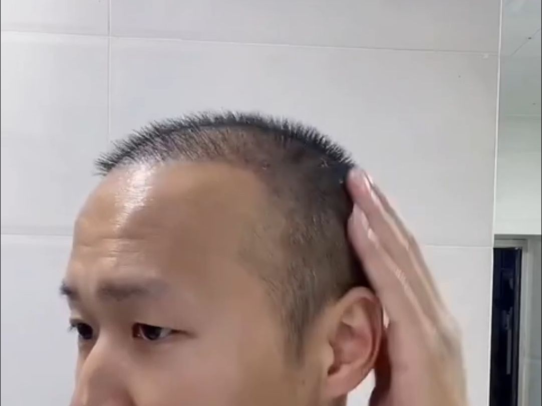 植发后发质生硬(植发后头发硬硬的)