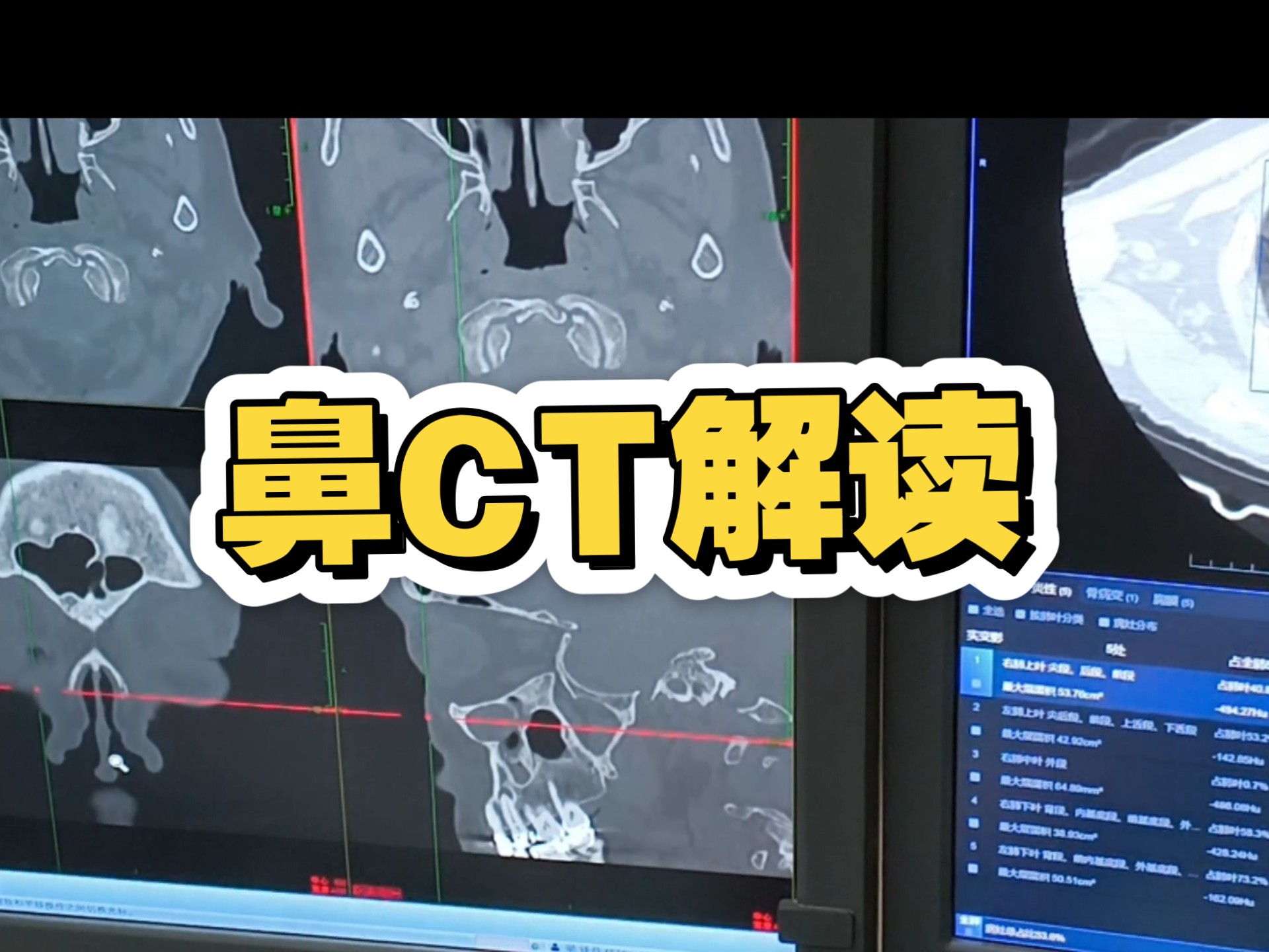 鼻ct解读