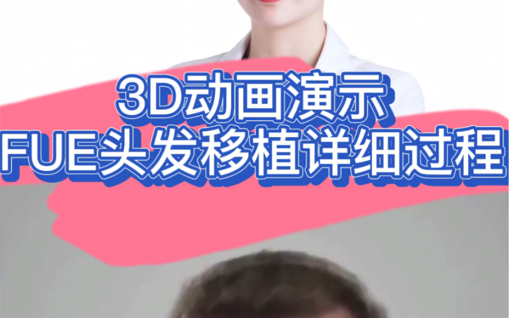 FUE植发技术3D演示哔哩哔哩bilibili