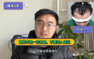 Descargar video: 植发不是一劳永逸，大家不要走入误区