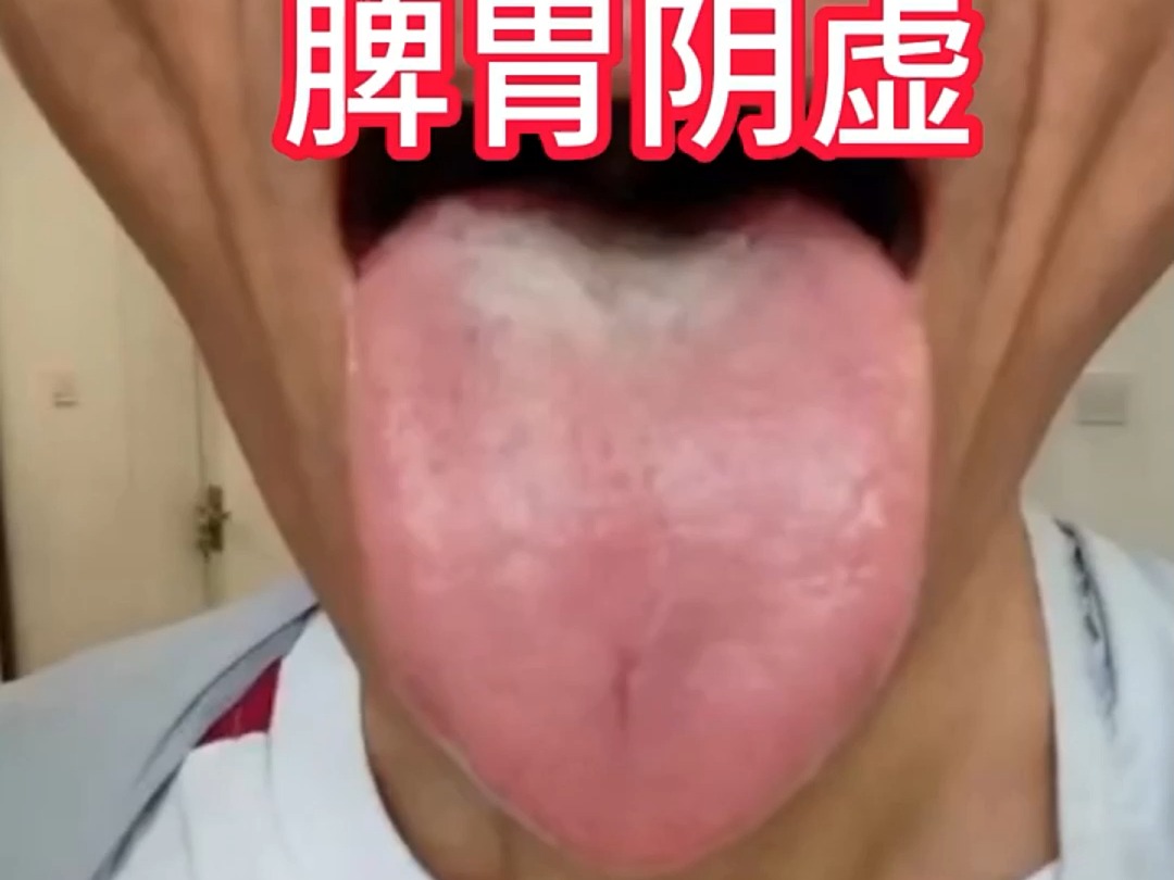 舌诊分析:肾阳不足,脾胃阴虚,上热下寒,失眠哔哩哔哩bilibili