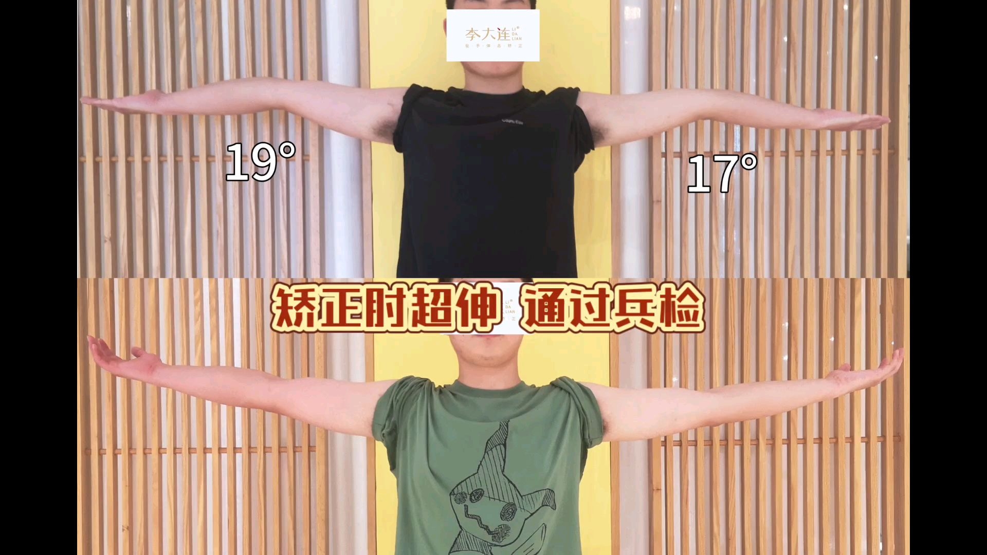 肘超伸矫正达到兵检标准