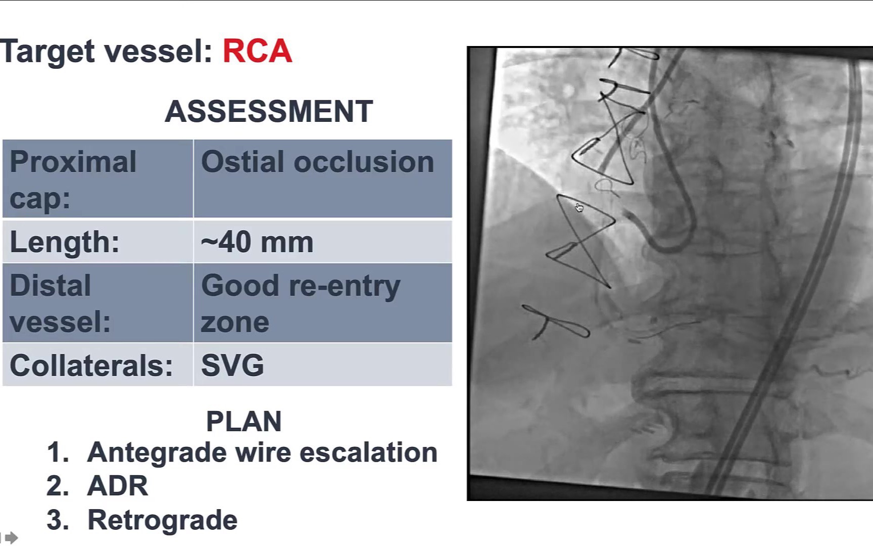 【转载】Coronary CTO Interventions Retrograde(RCA CABG术后,桥血管逆向)哔哩哔哩bilibili