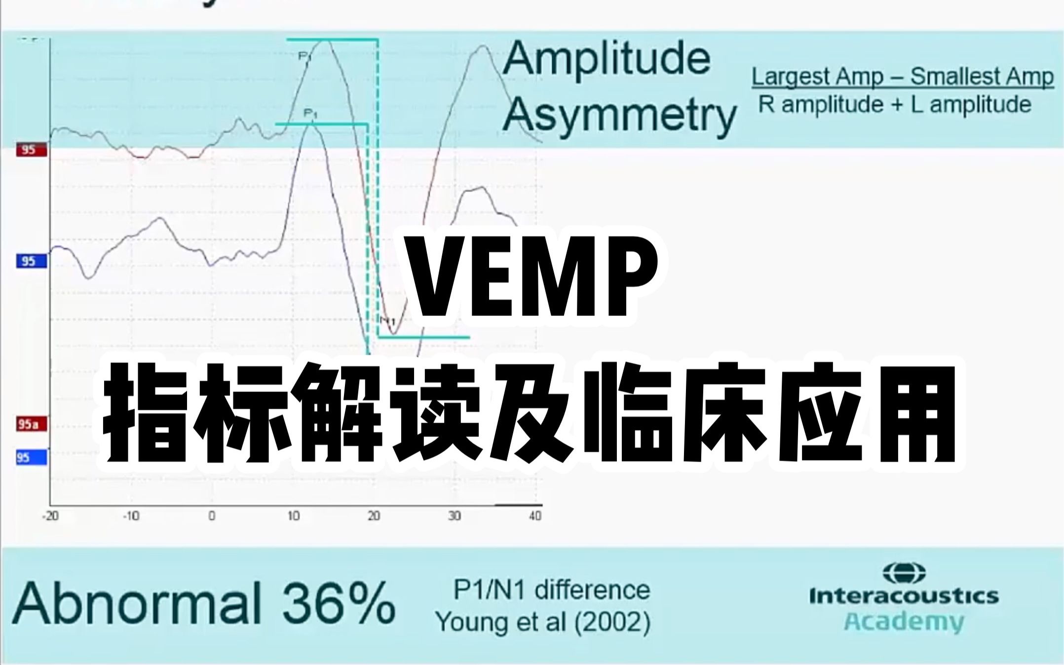 [图]VEMP ②如何解读VEMP的幅度、阈值和刺激声频率，VEMP临床应用| VEMP 前庭诱发肌源性电位| 油管搬运|双语字幕