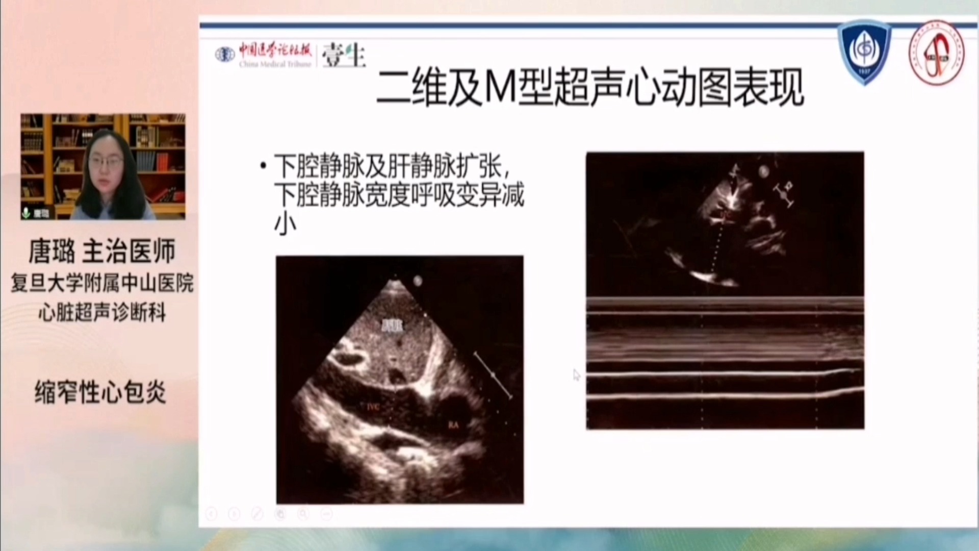 33,缩窄性心包炎的超声诊断——经胸超声心动图教学第三十三课