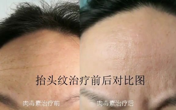 肉毒素注射治疗抬头纹对比图哔哩哔哩bilibili