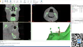 医学有限元分析-牙套颌骨三维重建geomagic装配