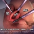 胸腔镜微创膈肌修补手术，3D演示。。