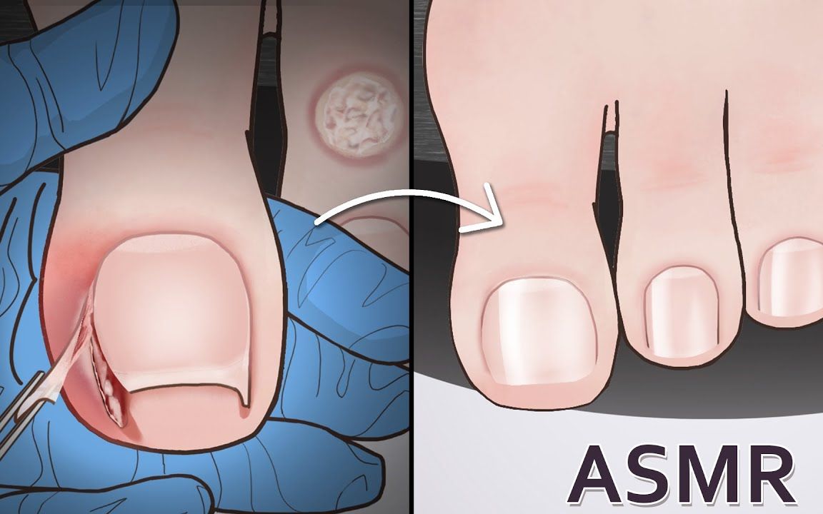 【沉浸式修脚】嵌趾甲和去鸡眼动画哔哩哔哩bilibili