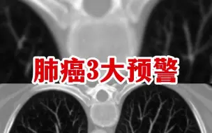 Video herunterladen: 肺癌3大预警狠狠记住能救命