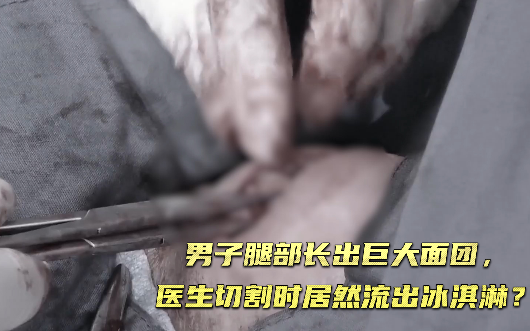 【挤痘大师】男子腿部长出巨大面团，医生切割时居然流出冰淇淋？ 竖版