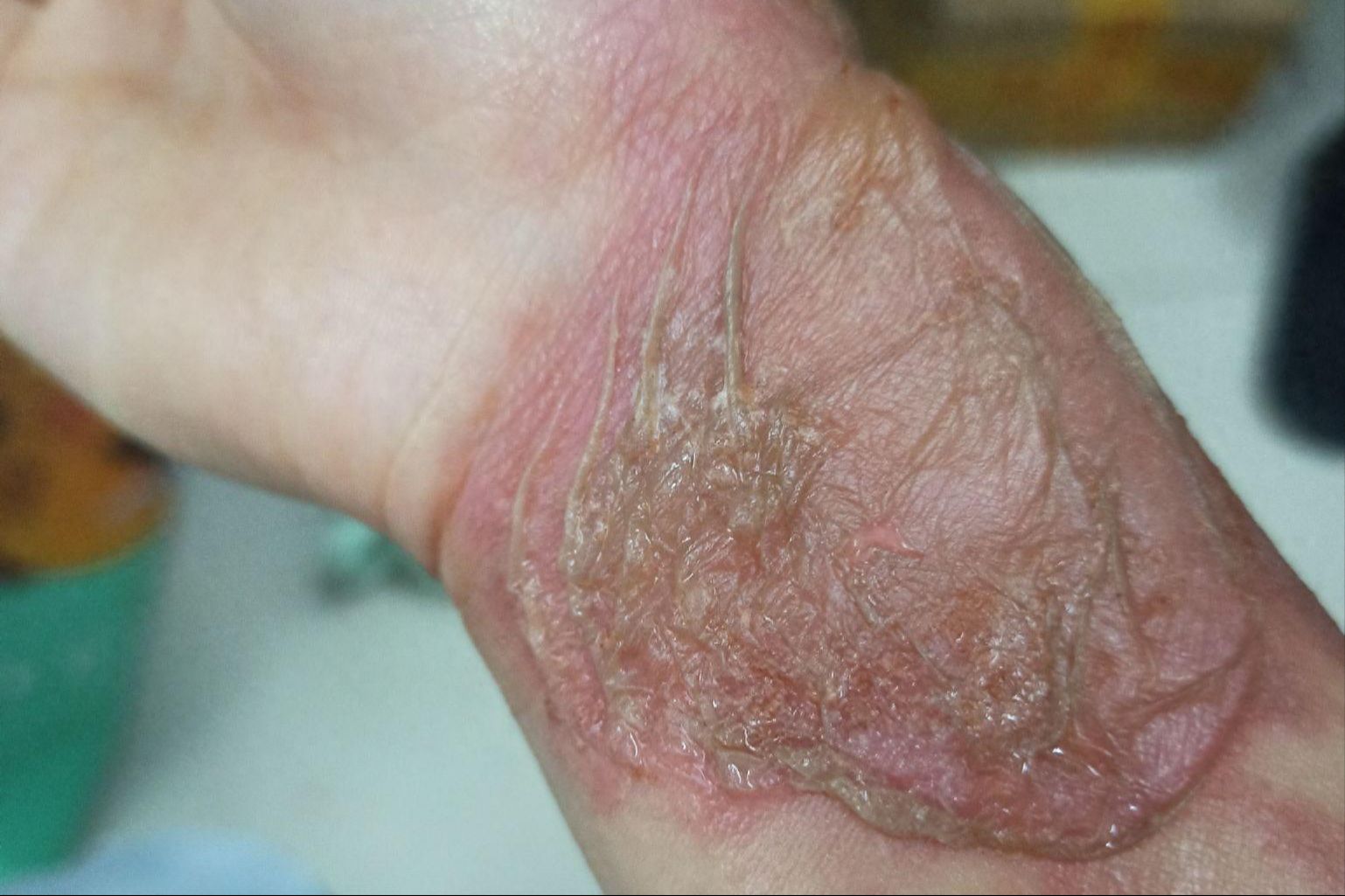 疤痕增生不是病,但是严重了也要命,赶紧重视起来吧!