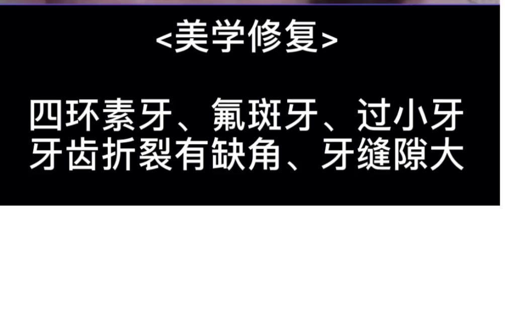 深圳全瓷牙贴面多少钱?氟斑牙/过小牙/四环素牙怎么办?一贴就还你自信漂亮牙齿!哔哩哔哩bilibili