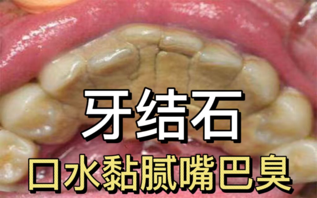 原来牙结石要这样做才能去除!这个方法简单一看就会!
