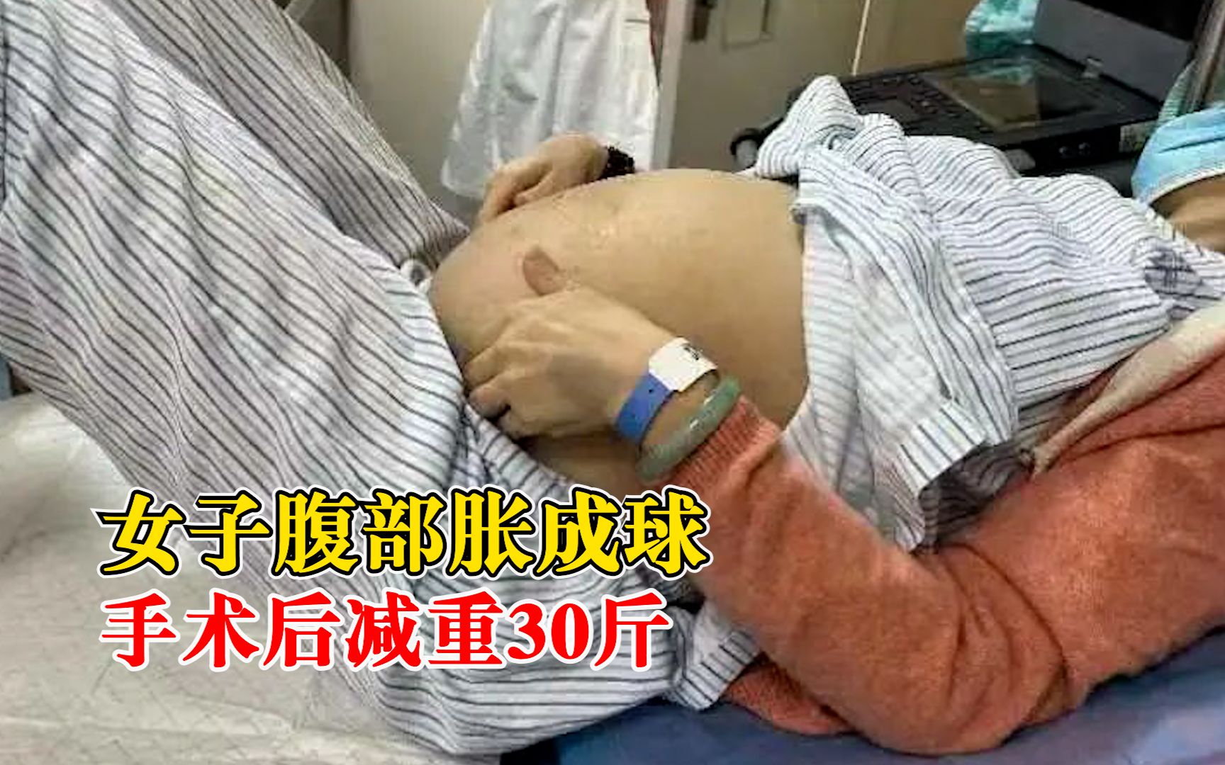 女子腹部胀成球手术后减重30斤:黏液性囊腺瘤,把器官都挤移位了哔哩哔哩bilibili