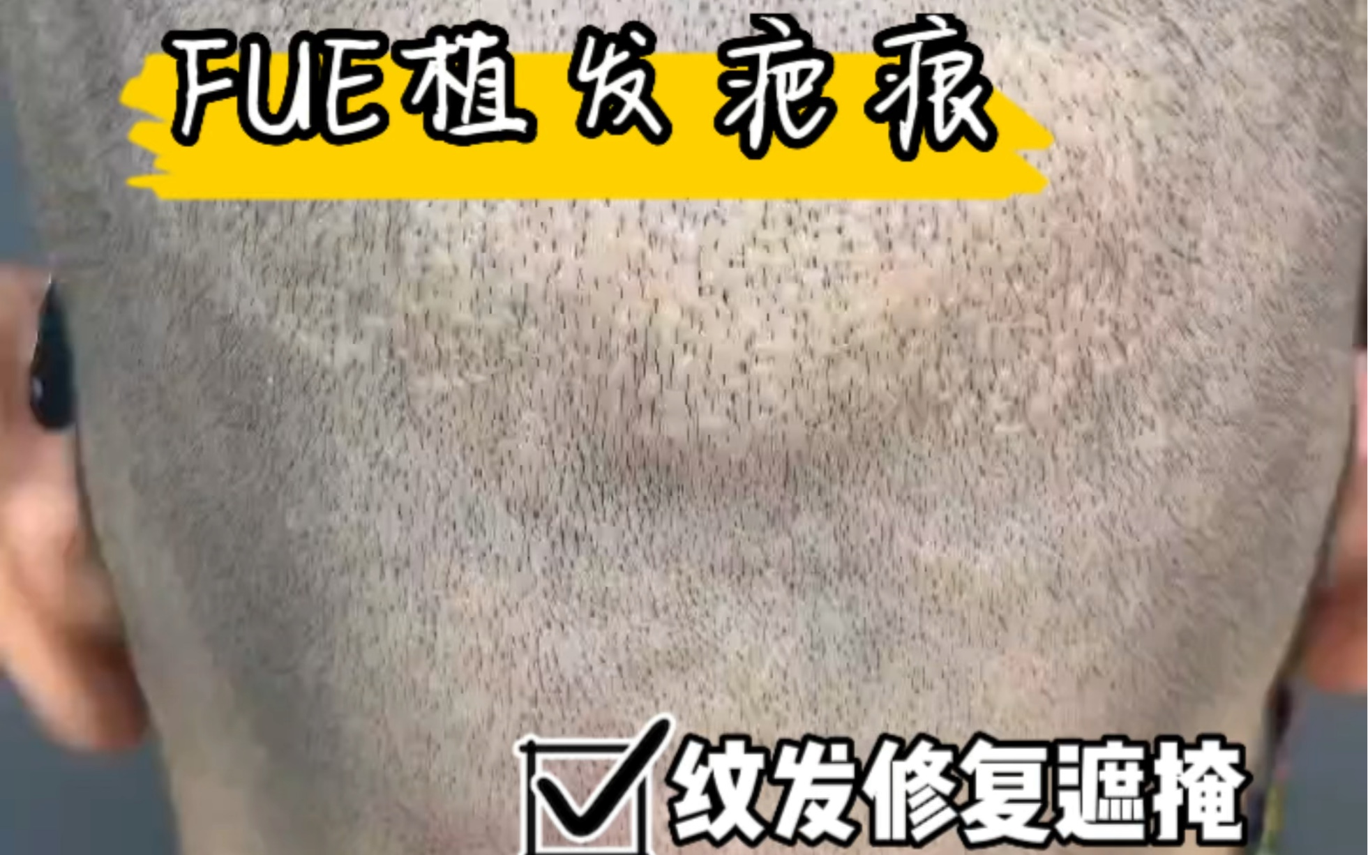 fue植发哪家便宜(fue植发大概需要多少钱一单位)