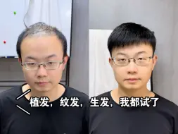 Tải video: 走过很多冤枉路的小哥，假发是终点站，也是唯一能解决问题的方法！