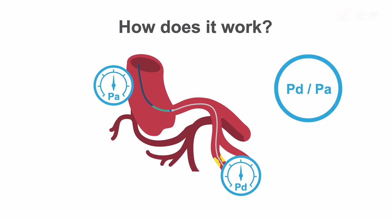 经皮冠状动脉介入治疗(PCI)哔哩哔哩bilibili