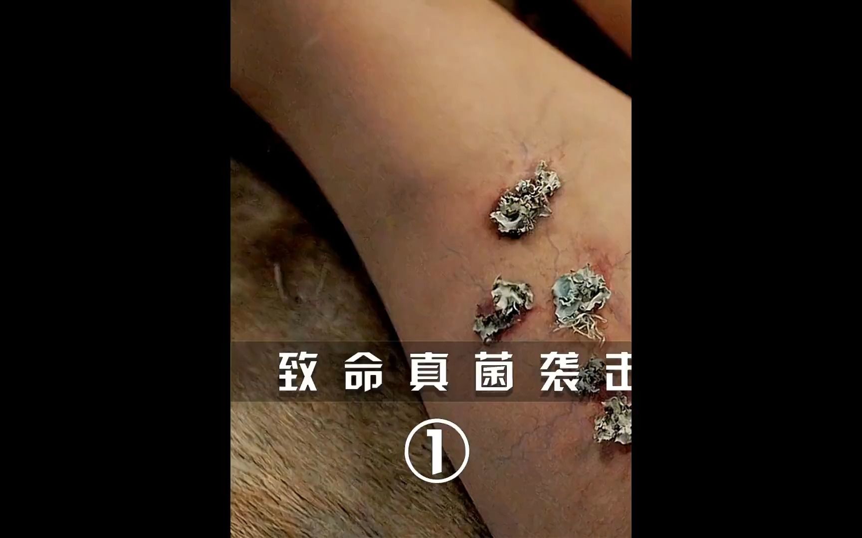 致命真菌袭击人类,感染者全身长满蘑菇!
