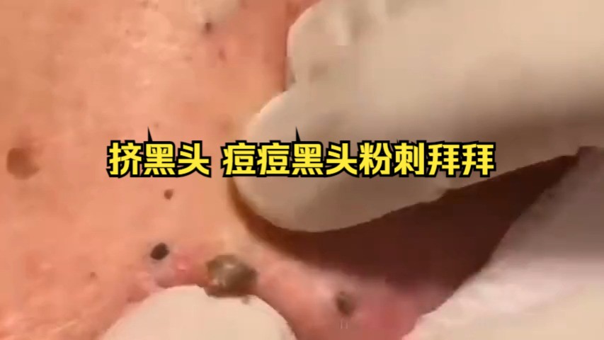 挤黑头 痘痘黑头粉刺拜拜 .