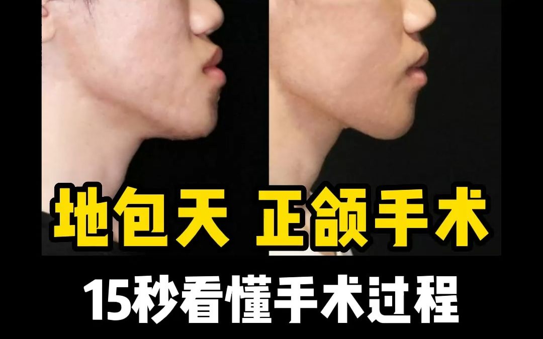 3d动画看懂正颌手术-地包天怎么办?