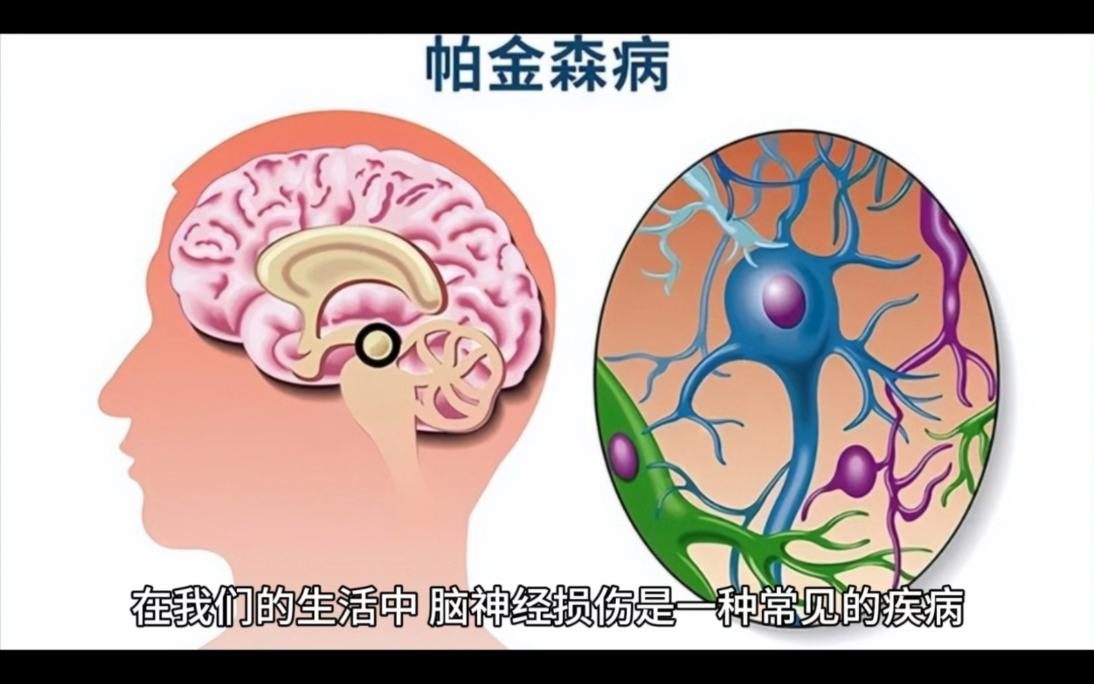 神经增强型干细胞修复脑神经损伤