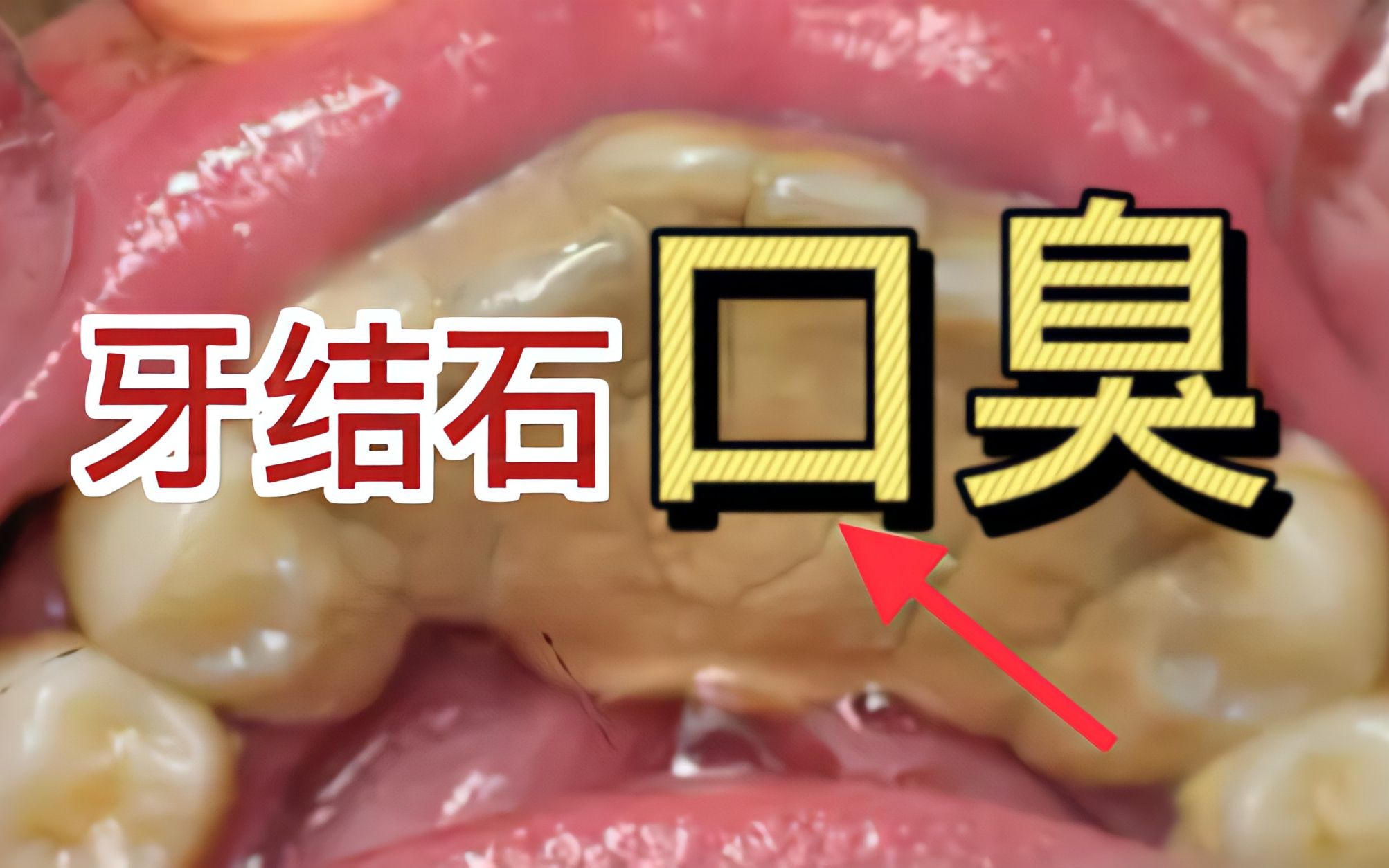 堆积如山的牙结石臭味熏天?掌握3个小妙招,45天在家口气清新!