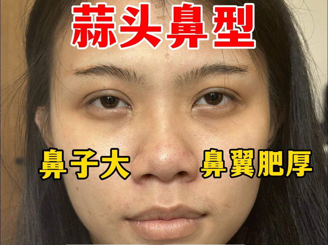 蒜头鼻成功逆袭妈生鼻