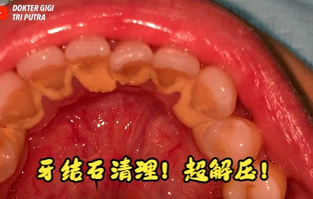 [图]【沉浸式洗牙】超解压的牙结石清理过程（3）！Dokter Gigi Tri Putra