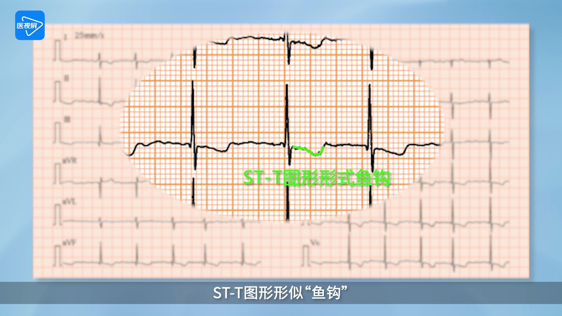 STT鱼钩状改变张新民老师讲解心电图哔哩哔哩bilibili