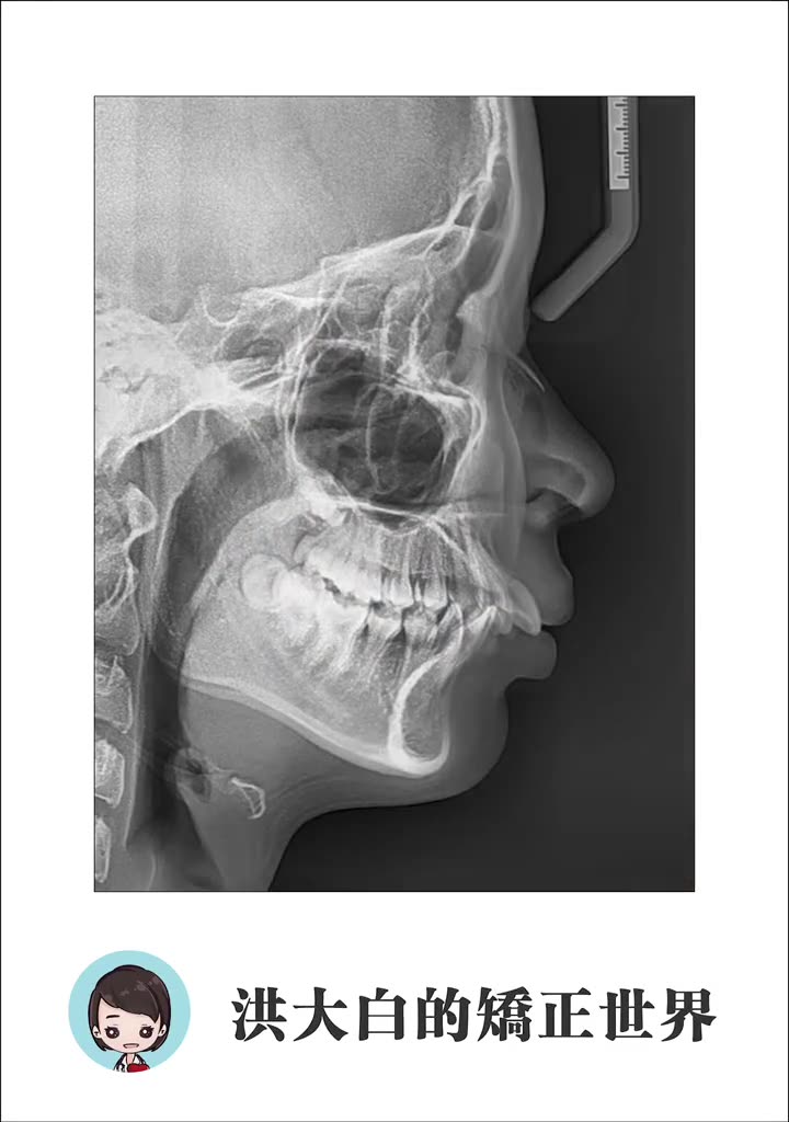 青少年牙齿矫正二类尖牙和磨牙关系病例,拔牙or不拔牙?哔哩哔哩bilibili