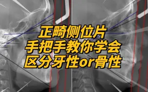 下载视频: 牙性骨性怎么辨认？带你看懂头颅侧位片