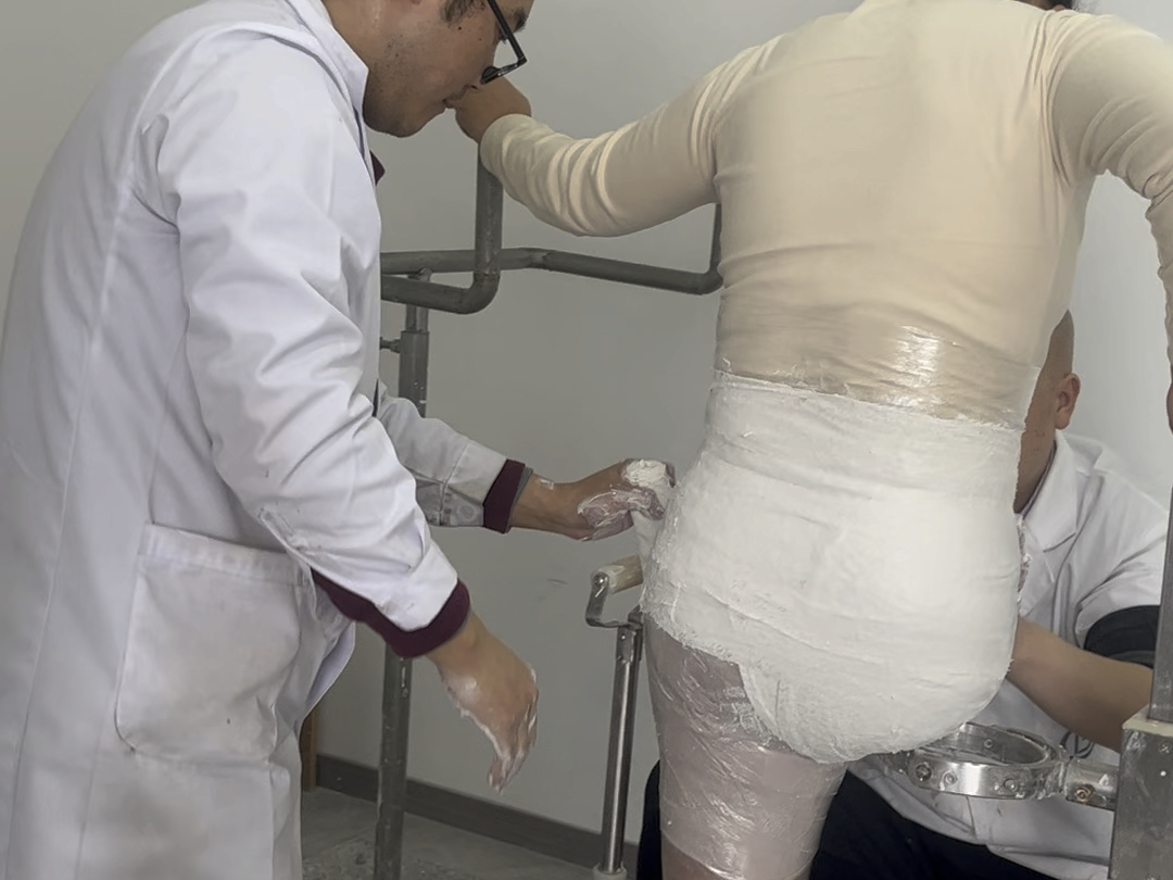 髋离断假肢取模,你们都能重新回归生活!