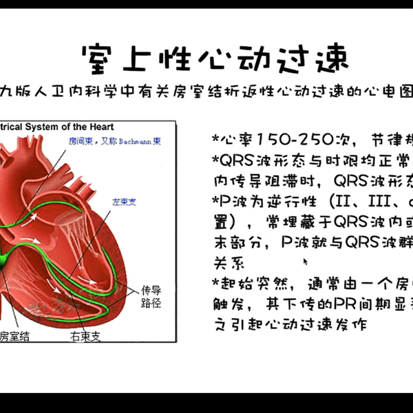 人卫第九版有关于阵发性室上性心动过速PSVT（房室结折返性心动过速 