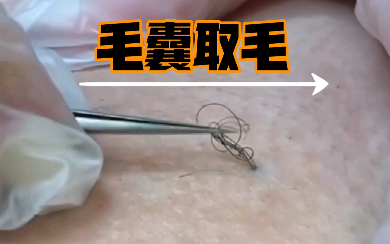 毛囊取毛解压视频