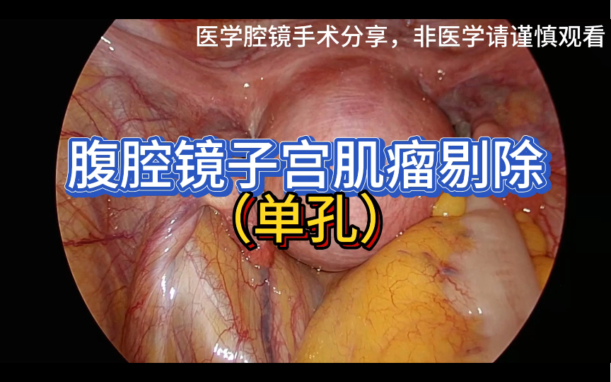 子宫肌瘤,(单孔)腹腔镜子宫肌瘤剔除术,手术解说分享,感谢.哔哩哔哩bilibili