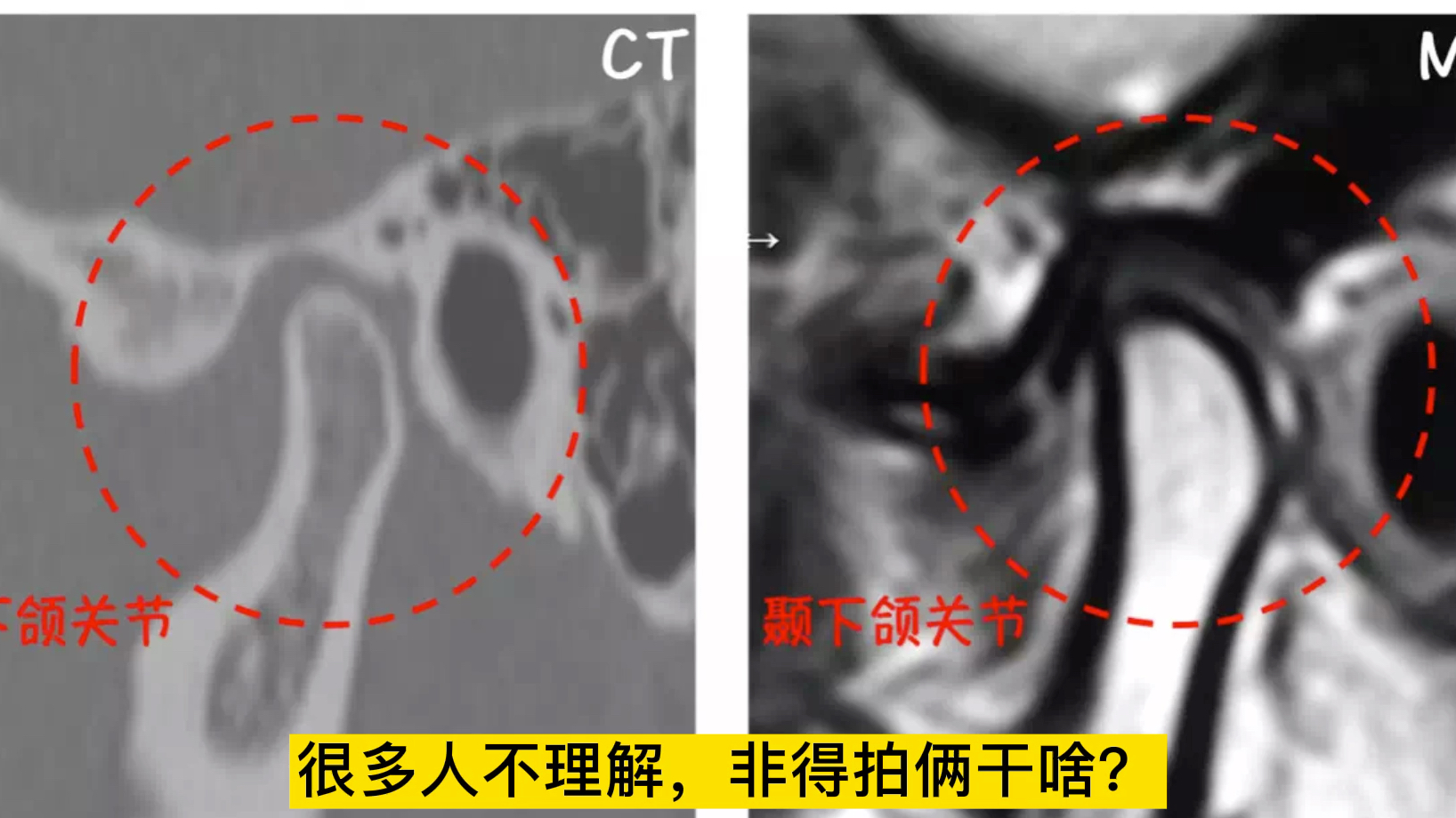 颞下颌关节紊乱为什么要拍那么多片子?