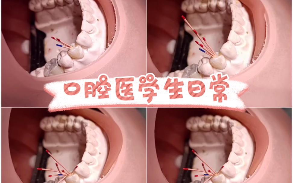 口腔医学生日常 根管治疗哔哩哔哩bilibili