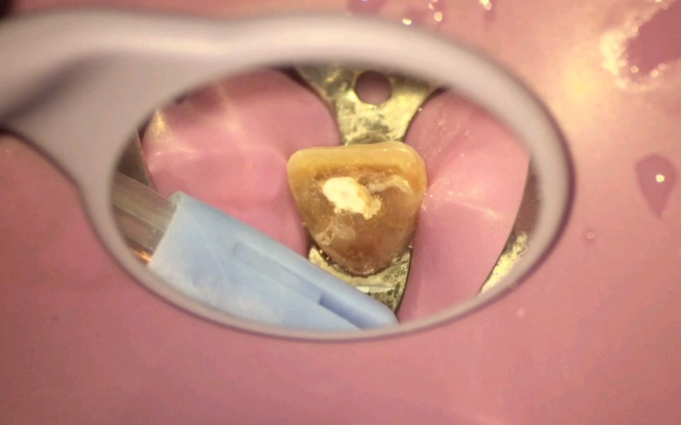 根管内氢氧化钙封药清除