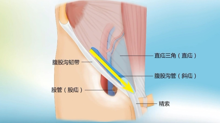 腹股沟疝（斜疝与直疝）