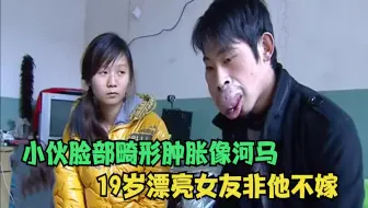 小伙脸部肿胀畸形像河马，19岁女友死心塌地非他不嫁，这就是爱情
