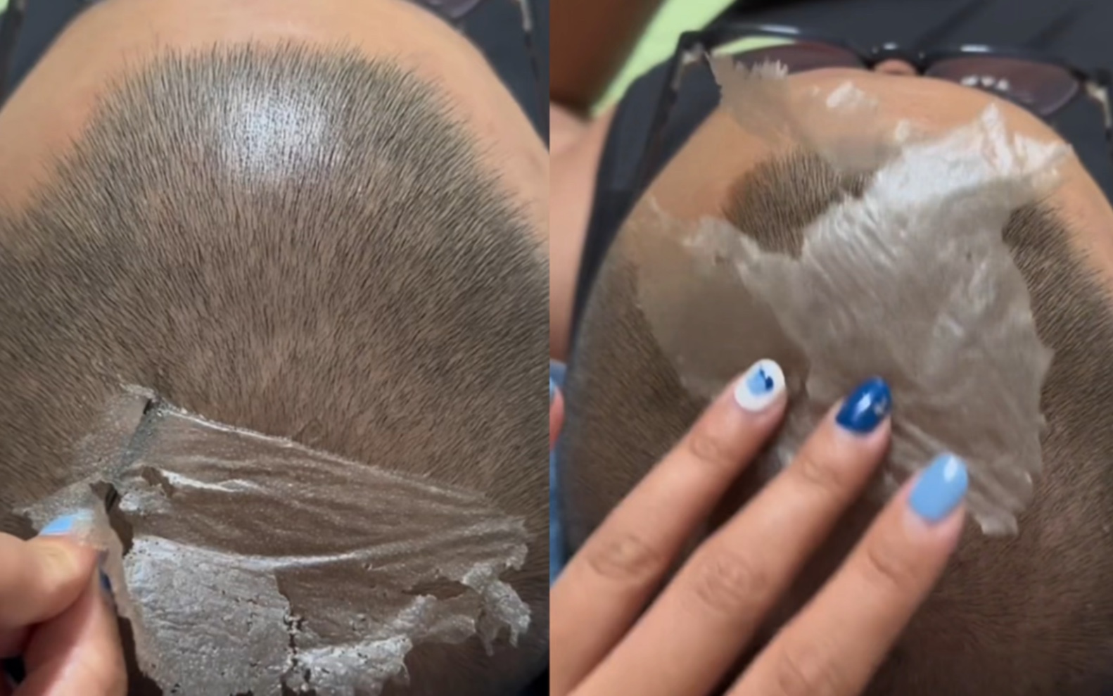 女子帮老公挠头顶解痒,不料撕下超大一块头皮,头顶瞬间光洁如新