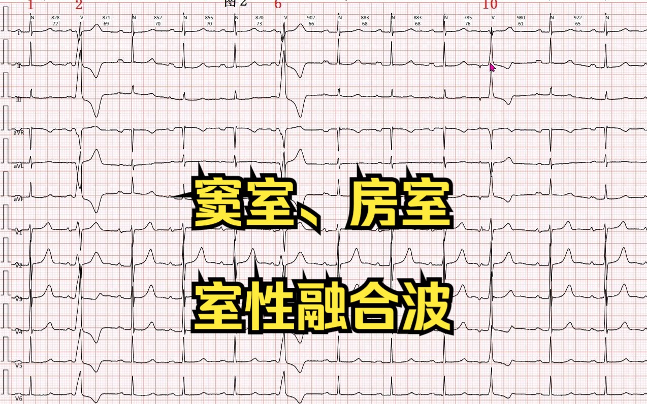 室性融合波心电图表现图片