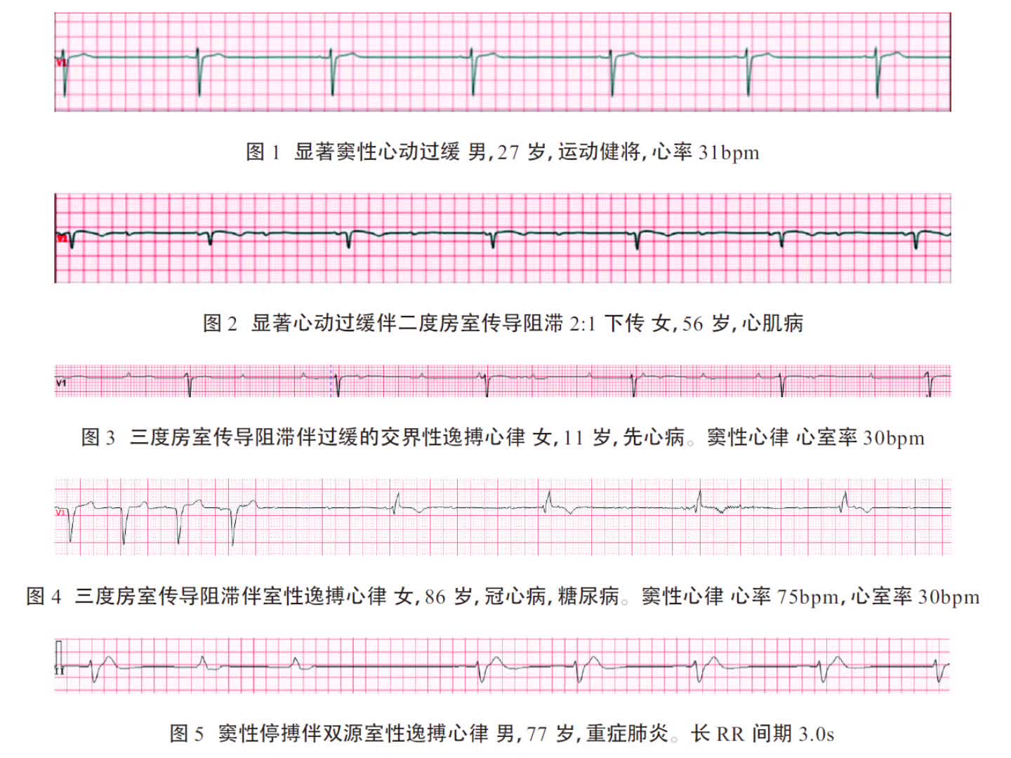 严重的心动过缓心动过缓是指心室率低于60bpm 的心脏跳动速率,严重的心动过缓一般是指心室率低于45bpm,需要危急报警的界值是心室率低至35bpm 及...