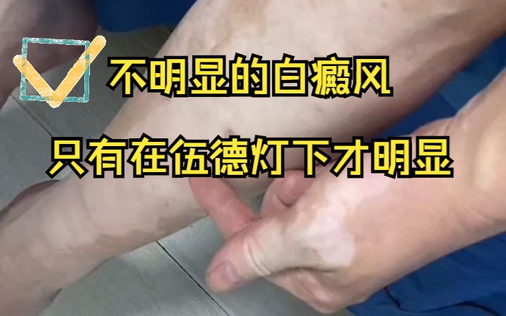 不明显的白癜风皮损只有在伍德灯下才明显
