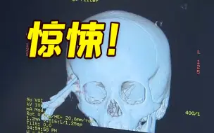 Descargar video: 上海一名5岁女童玩耍时从床上跌落 剪刀插入脑颅2公分