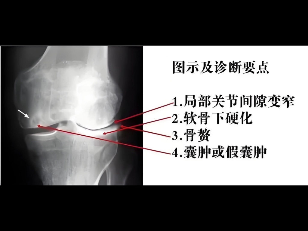 膝关节正位片:膝关节退行性病变.哔哩哔哩bilibili