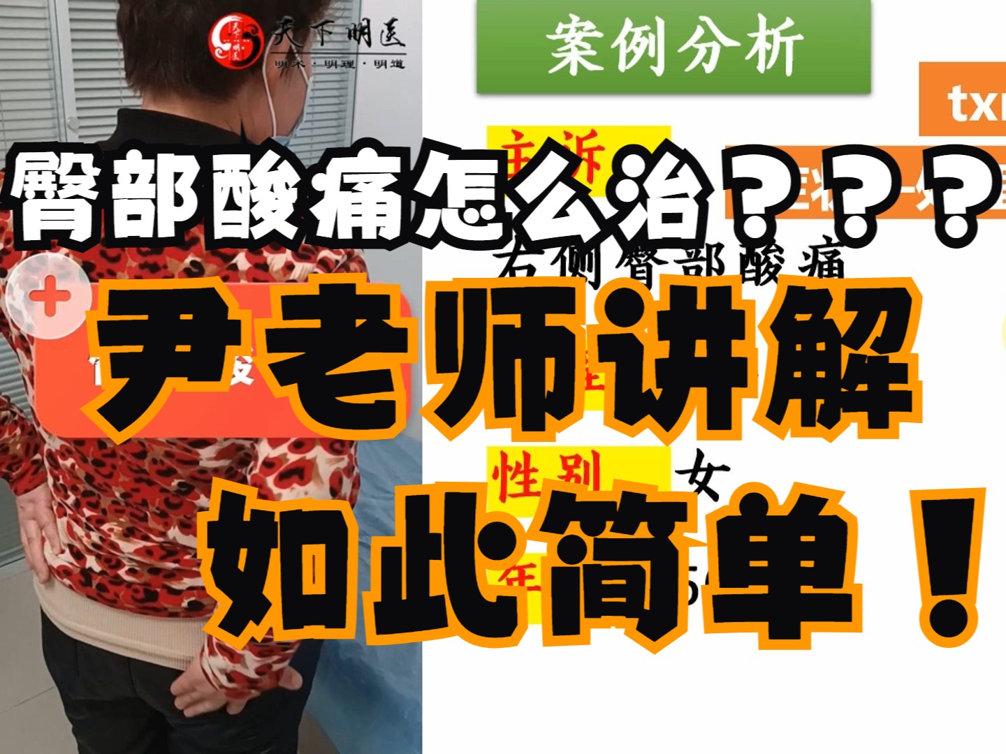 臀部酸痛【病例分析】(右侧臀部酸痛)——使用天下明医平台简灵奇针第