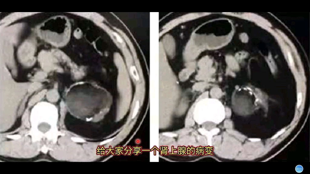 肾上腺“畸胎瘤”在腹部CT上什么表现?专科医生分享典型病例哔哩哔哩bilibili