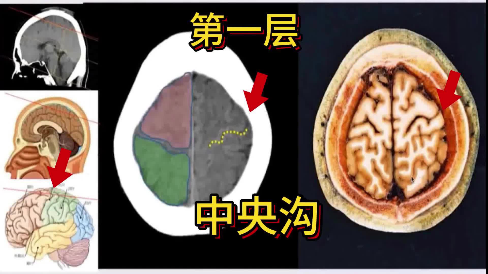 [图]头颅CT如何看，断层解剖（一）